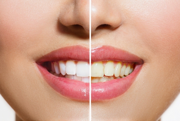 teeth whitening before and after photo - Lakewood cosmetic dentist