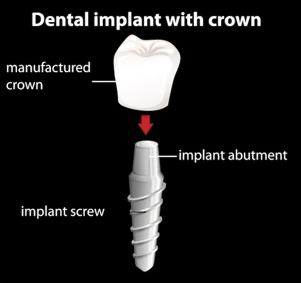dental implant diagram - Lakewood implant dentist
