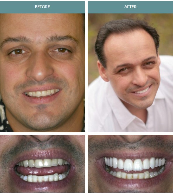 man smiling before and after veneers, smile fuller after