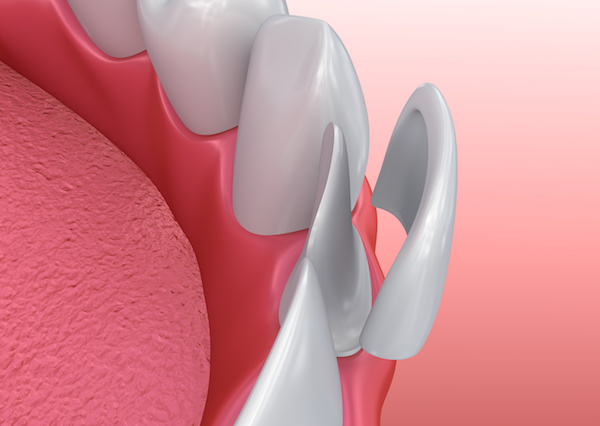up close illustration of porcelain veneer being placed on lower tooth