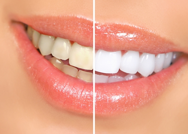 teeth whitening patient in Denver - before and after photo 