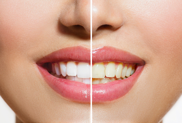 Stained Teeth - Before & After Tooth Whitening