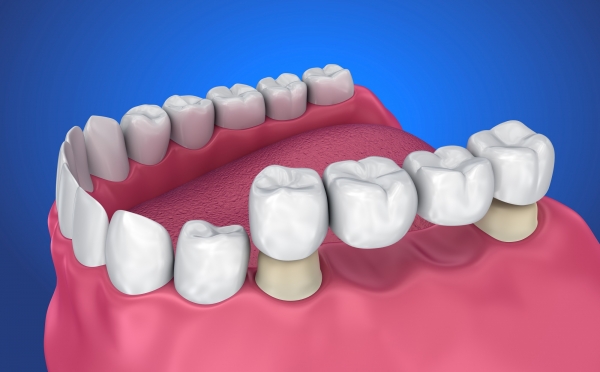 illustration of a dental bridge