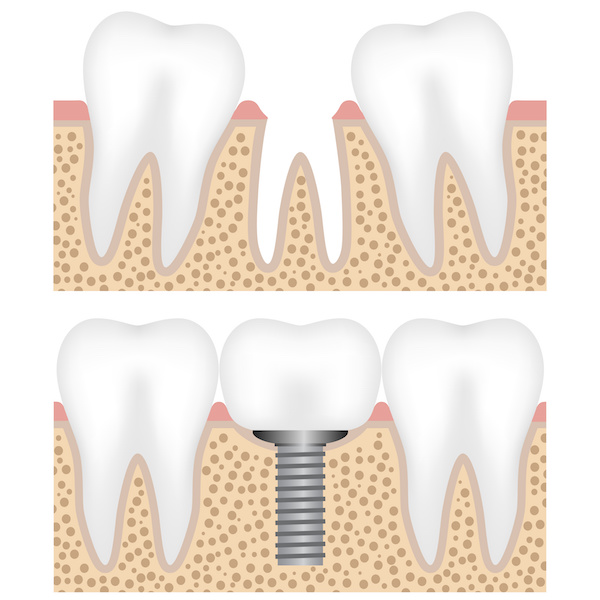 Dental Implants