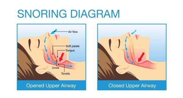 illustration of obstructive sleep apnea