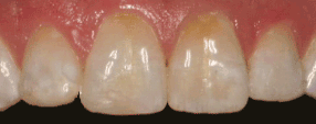 Timelapse of Dental Bonding - Before & After Gif