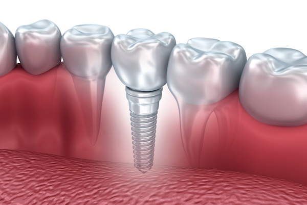 What Are the Benefits of Dental Implants? | Dr. Greenhalgh