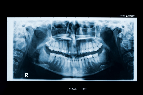 digital x-rays for a Lakewood dental patient