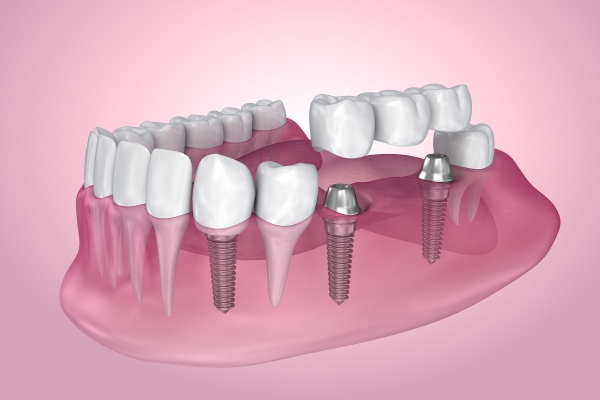 illustration of an implant-supported dental bridge